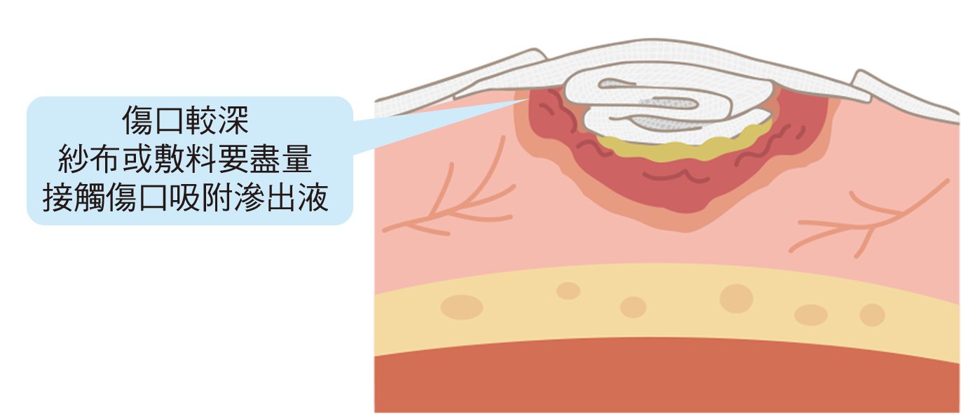 認識壓力性損傷