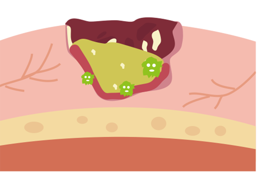 認識壓力性損傷